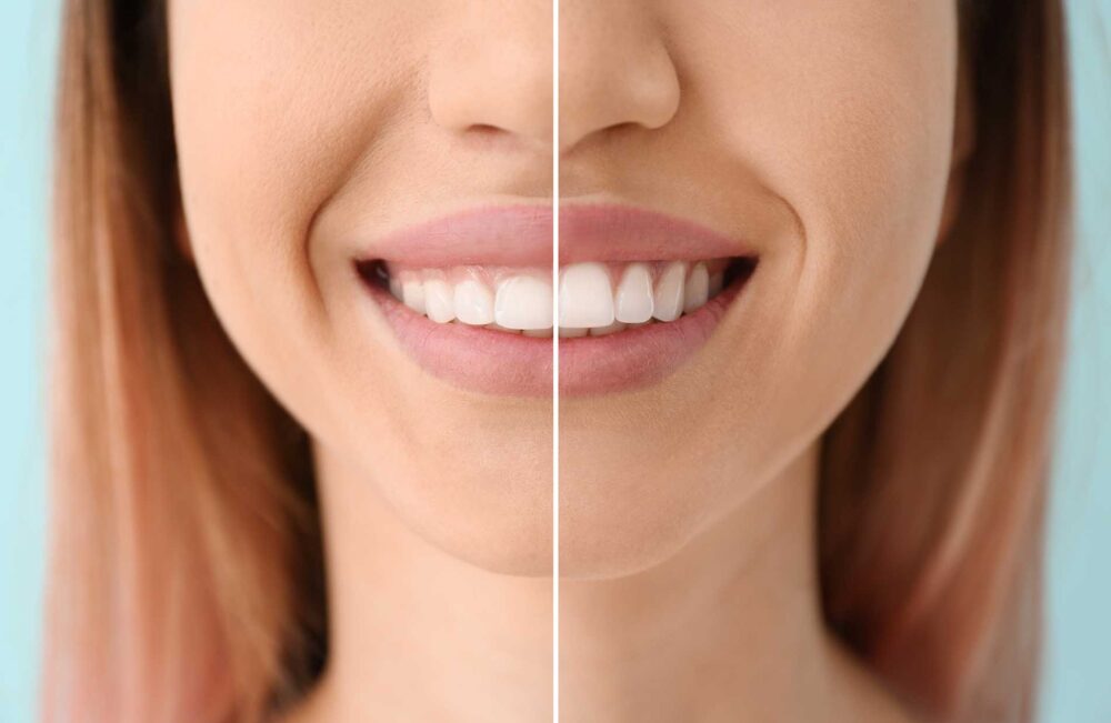 Beautiful gums through cosmetic gum correction