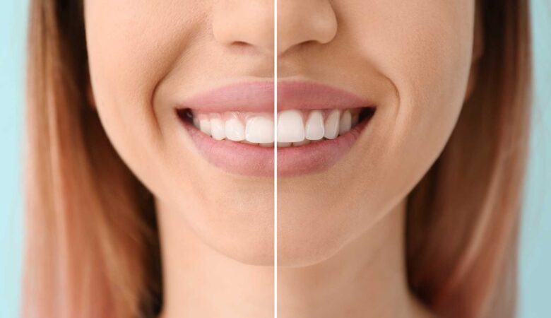 Beautiful gums through cosmetic gum correction