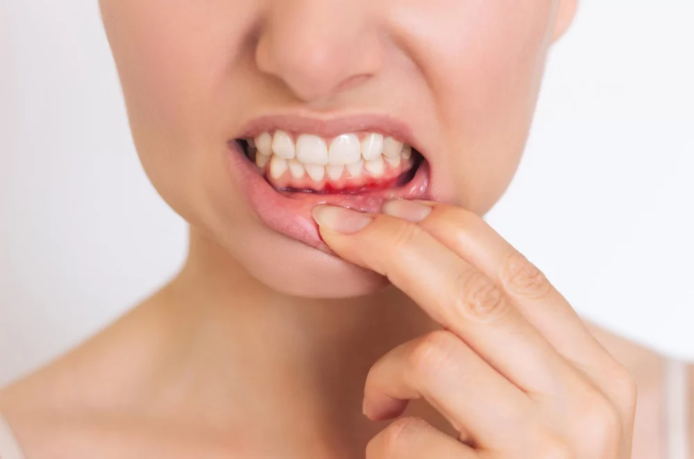 Bleeding gums: A warning sign that you should take seriously