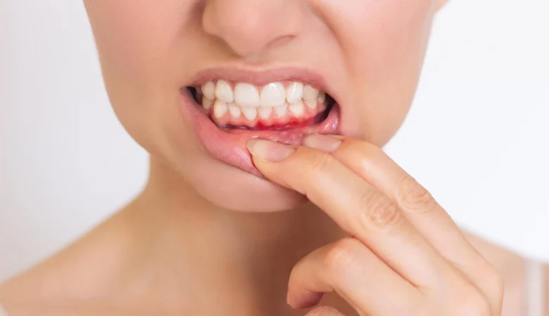 Bleeding gums: A warning sign that you should take seriously