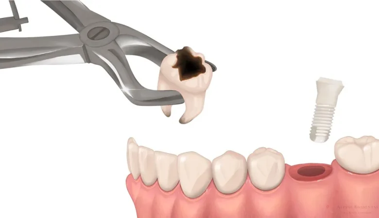 Dental implant: What advantages does the immediate implant method offer and who is it suitable for?