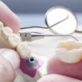 Everything you need to know about dental crowns