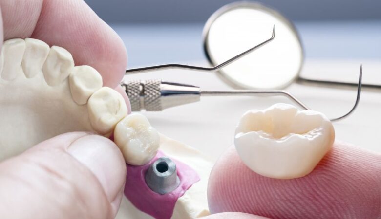 Everything you need to know about dental crowns