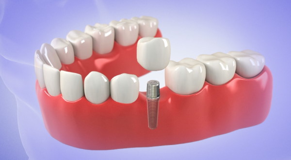 Fixed third teeth: Implant dentures in one day