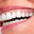 Gum Lifting: How to Restore Your Smile