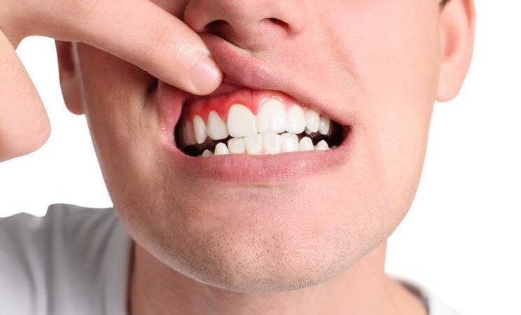 Gum recession: Why do gums recede and what can you do about it?