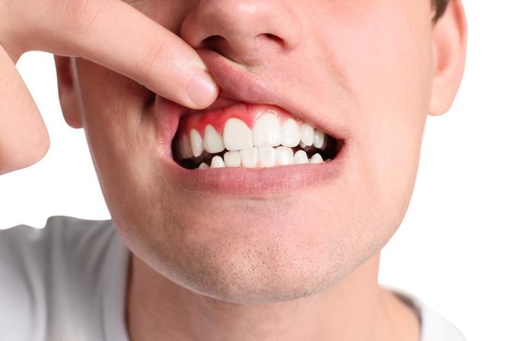Gum recession: Why do gums recede and what can you do about it?