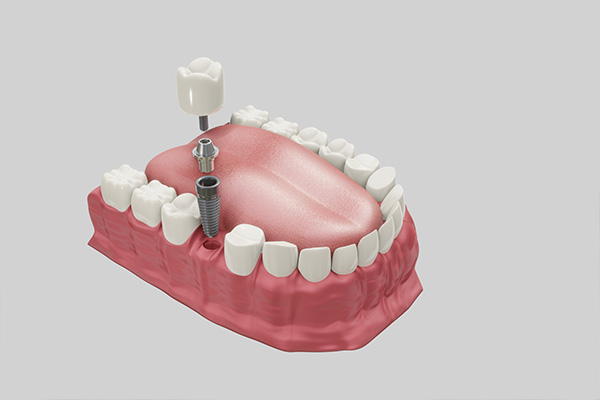 Implants and permanent dentures in one day