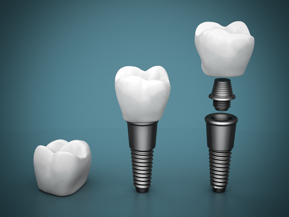 Interesting facts about implants
