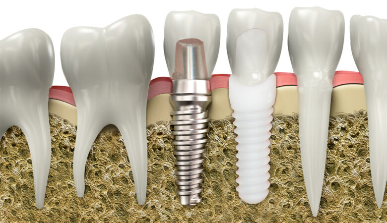 Titanium or ceramic: which is the better implant?