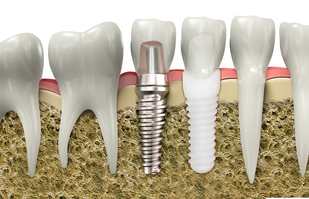 Titanium or ceramic: which is the better implant?